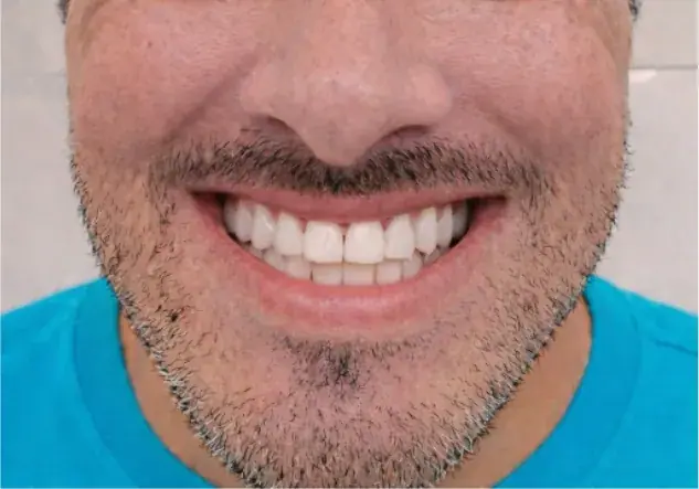 Full-arch smile restoration — After