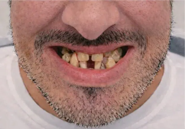 Full-arch smile restoration — Before