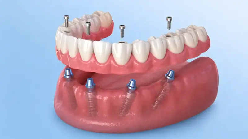 Full-arch implant bridge on a jaw model