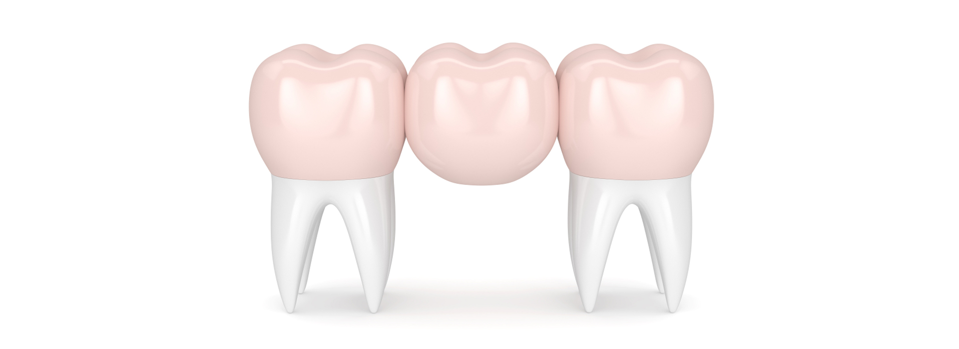 Dental Bridge – Types, Costs, Problems & Difference To Implants